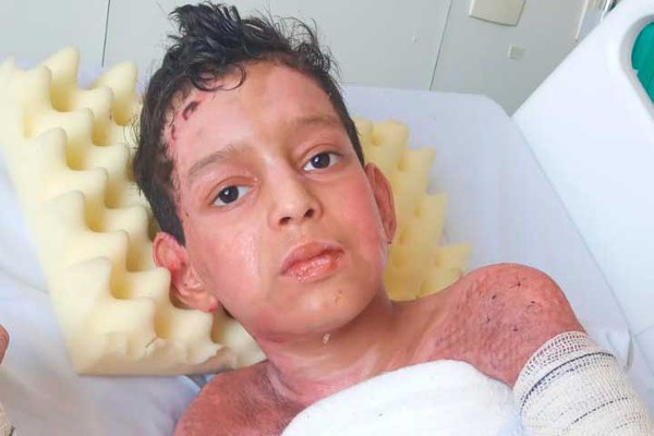 Após 55 dias de internação, garotinho que teve 80% do corpo queimado volta para casa