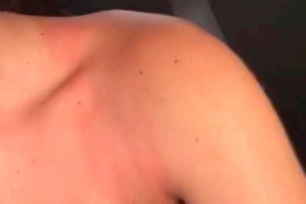 Adolescente de 16 anos fica com marcas pelo corpo após ser agredida pelo namorado