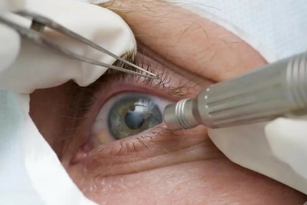 Médicos alertam para riscos de cirurgia de mudança da cor dos olhos