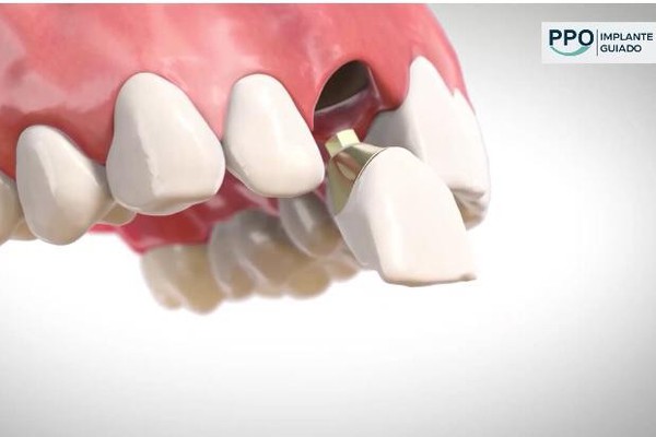 Implantes dentários com Cirurgia Guiada, inovação que traz benefícios ao paciente; conheça
